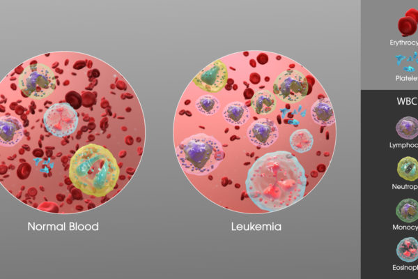 Leukemia Causes