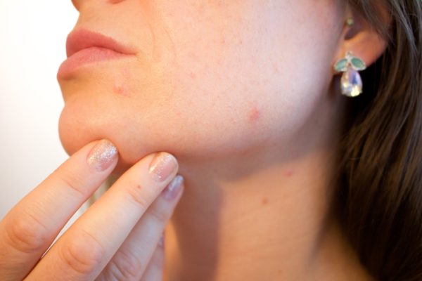 how to get rid of acne scars