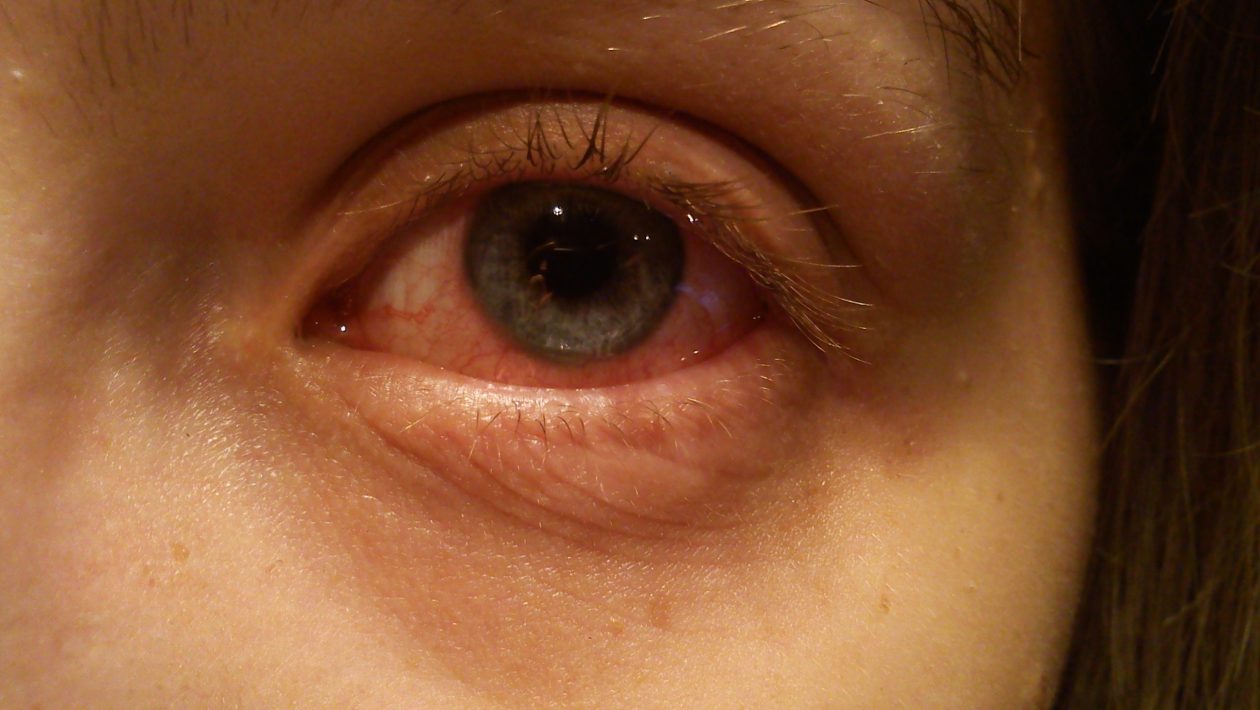 How Long Is Pink Eye Contagious