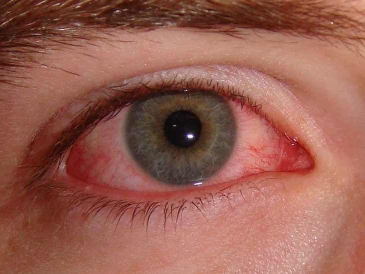 How long is pink eye contagious