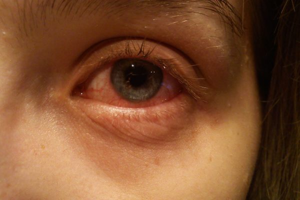 How Long Is Pink Eye Contagious