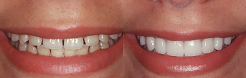 Dental Veneers Before and After