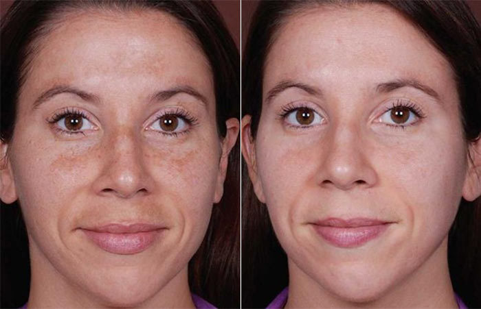 How to Cure Melasma from the Inside 
