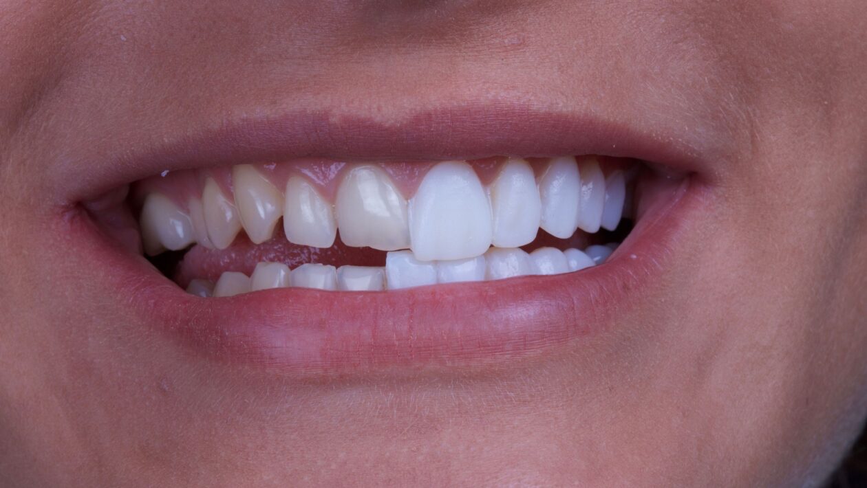 Dental Veneers